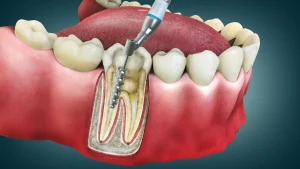 5 Myths About Root Canals That Need To Go Away