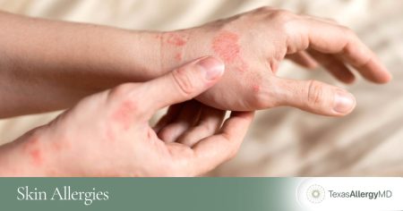 Dealing with Skin Allergies? Here’s What Experts Say